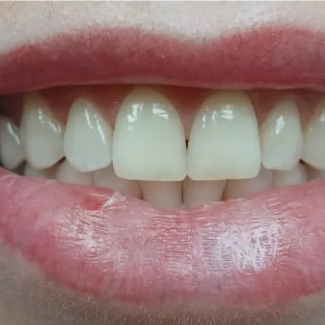 Smile after cosmetic treatment with closed gaps and an even smile line