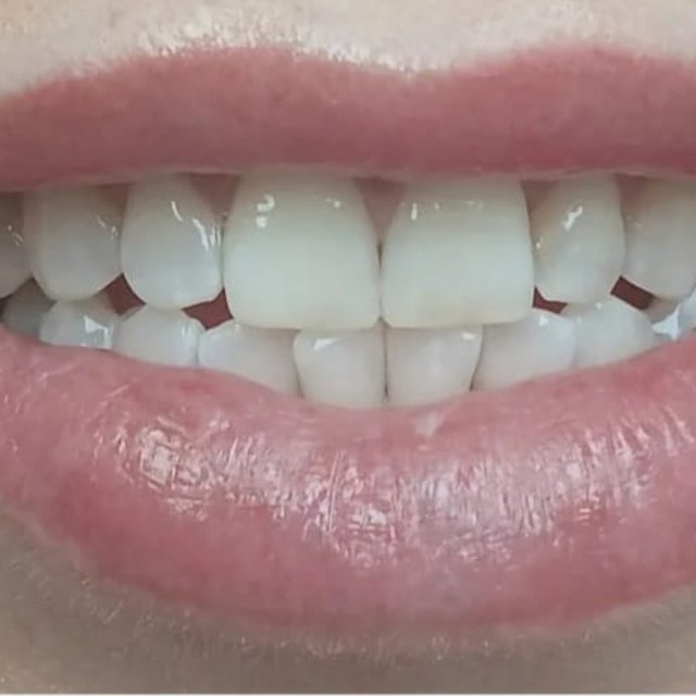 Smile before cosmetic treatment showing uneven edges and small gaps