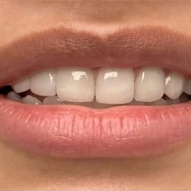 Smile after porcelain veneers with a bright, even upper arch